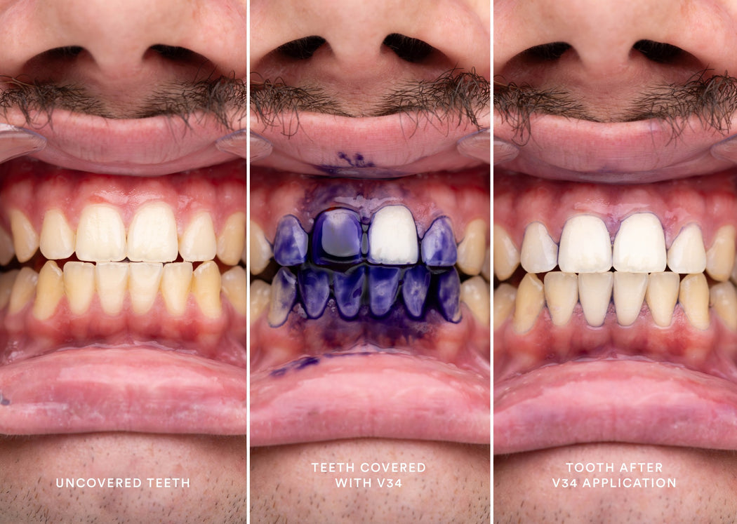 Hismlie Instant Teeth Tone-Up Serum